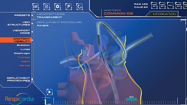 Respicardia, see inside the heart in real-time